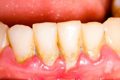 Bác sĩ khuyên bạn nên lấy cao răng tại hải phòng 6 tháng 1 lần