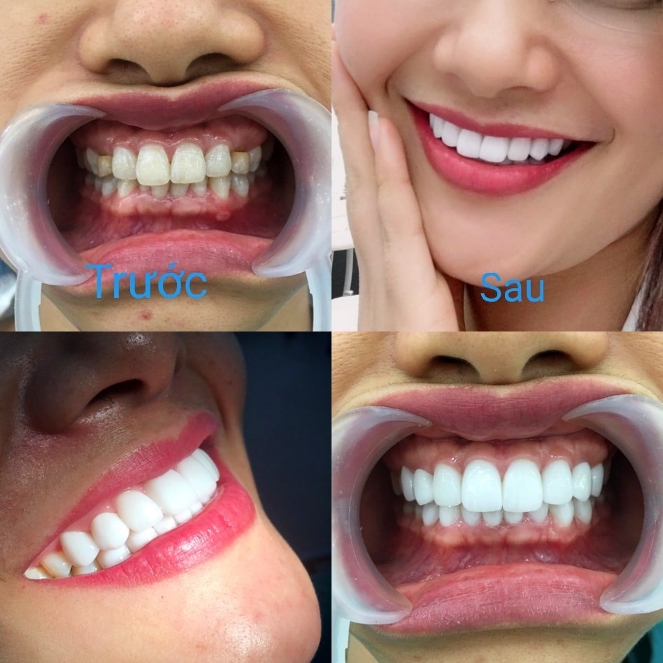 12 điều bạn cần biết khi bọc răng sứ thẩm mỹ