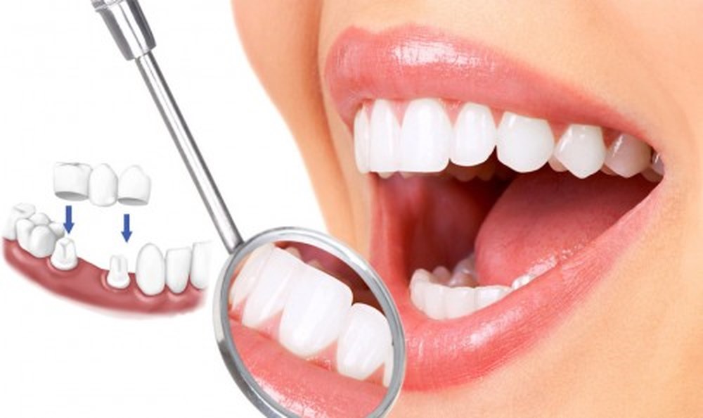 Bọc răng sứ thẩm mỹ tại hải phòng có được vĩnh viễn không?