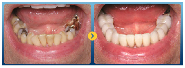 Giá bọc răng sứ cho răng sâu bao nhiêu tiền? Có nên bọc răng sứ cho răng sâu?