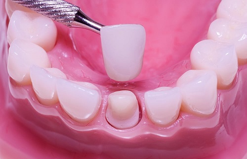 Chất lượng răng sứ thẩm mỹ Hải Phòng phải bền đẹp