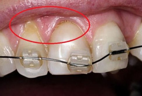Niềng răng sai cách gây chết tủy răng