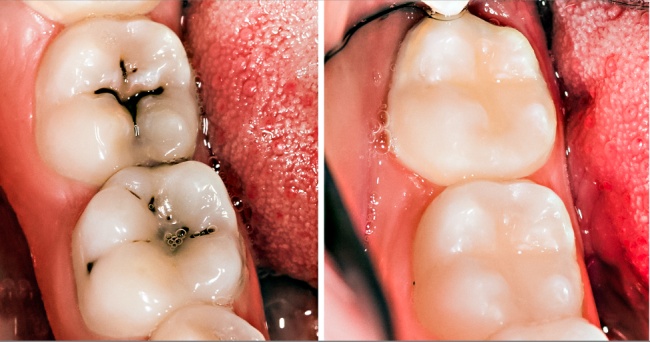 giá bọc răng sứ tại Hải phòng cho răng sâu