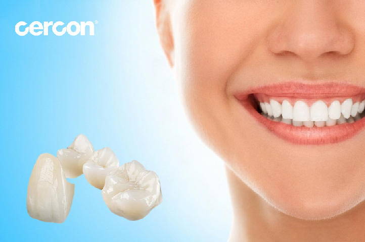 Răng sứ Cercon là gì?