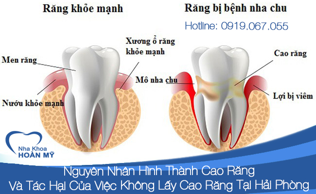 nguyên nhân hình thành cao răng và tác hại của khi không lấy cao răng tại Hải Phòng