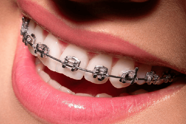 Niềng răng một hàm