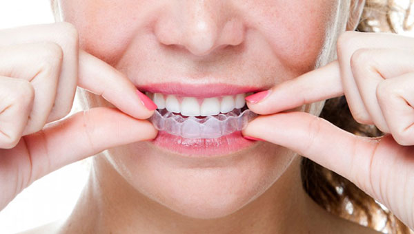 niềng răng trong suốt ở Hải Phòng bạn có thể tự tháo lắp và vệ sinh dễ dàng