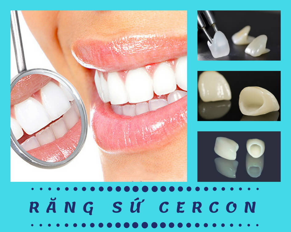 Bọc răng sứ Cercon