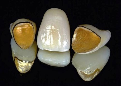 Răng sứ kim loại quý