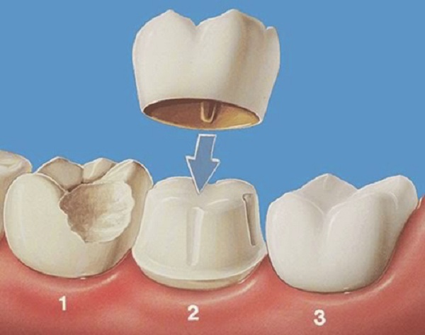 review quy trình bọc răng sứ titan