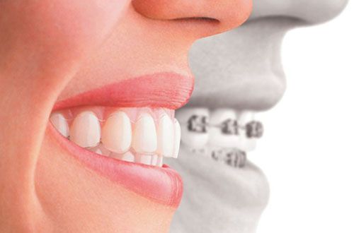 Sự khác biệt giữa niềng răng mắc cài và không mắc cài
