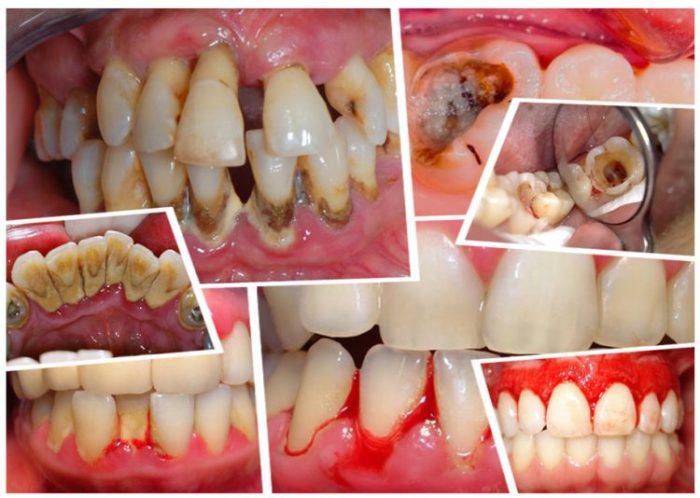 Tác hại khi tự lấy cao răng tại nhà