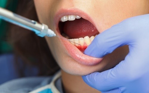 Trám răng thẩm mỹ chích thuốc tê trong những trường hợp cần thiết
