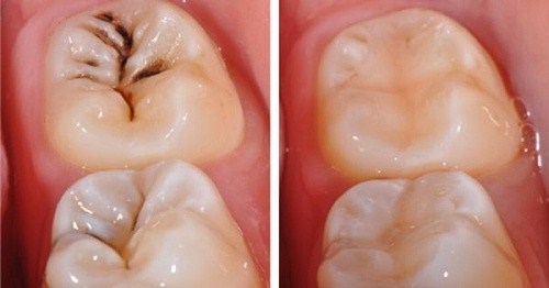 Trám răng thẩm mỹ hải phòng chích thuốc tê khi thực hiện điều trị bệnh lý