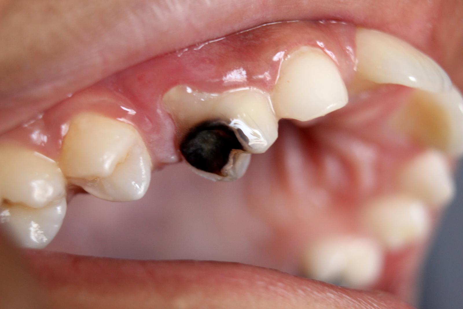 Triệu chứng của sâu răng