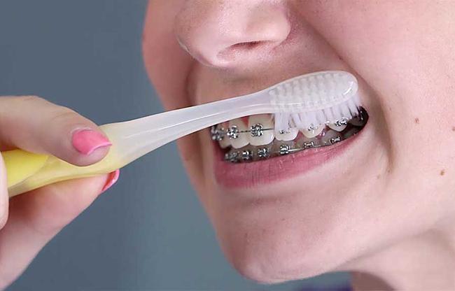 vệ sinh răng miệng cho người đang niềng răng Hải Phòng