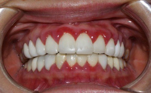 Viêm lợi sau làm răng sứ