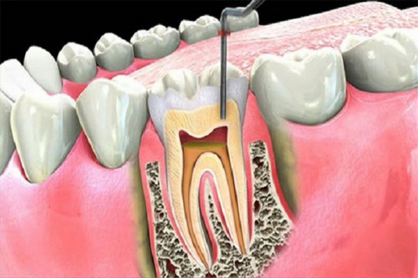 Bọc răng sứ sau khi điều trị tủy